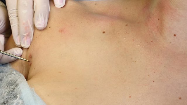Surgery concept. Electrocoagulation of papillomas. Close-up shot of doctor burns papillomavirus with medical tools and equipment on female body. Papillomas removal. 4 k footage