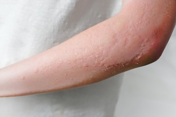 Skin rashes, allergies contact dermatitis