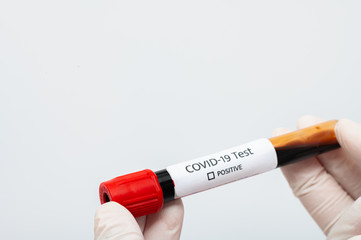 Coronavirus 2019-nCoV Blood Sample. blood for corona, covid-19 virus examination, collected to do a battery of laboratory tests.