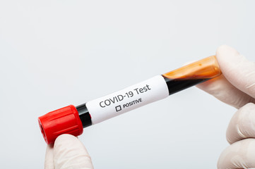 Coronavirus 2019-nCoV Blood Sample. blood for corona, covid-19 virus examination, collected to do a...