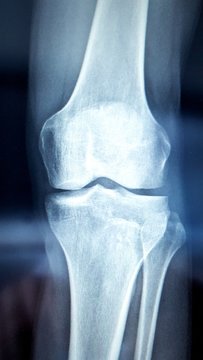 X-ray Image Of Bone