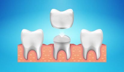 Dental Crown Restoration in realistic style. Medically accurate. Vector illustration 