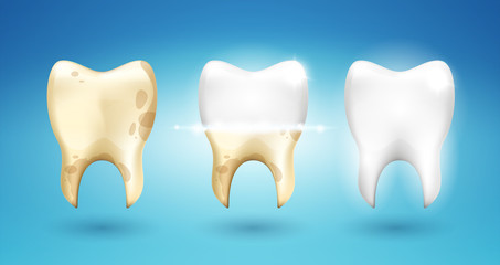 Tooth dental brushing in 3d style. Stages of calculus and caries removal. Process of teeth whitening. Stomatology dentistry. Vector realism illustration.