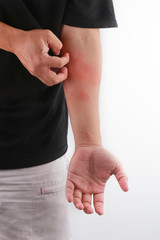 Close up dermatitis on the skin, ill allergic rash dermatitis eczema skin of a patient.
