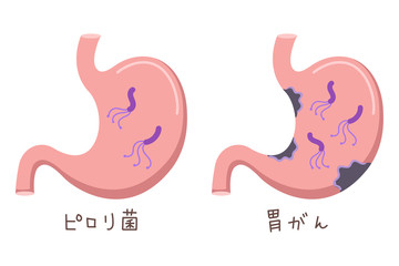 胃の中の菌のイラスト（ピロリ菌・胃がん）