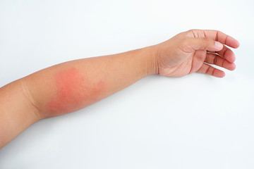 Close up dermatitis on the skin, ill allergic rash dermatitis eczema skin of a patient.