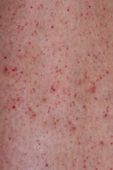 Close up of petechiae rash on a leg