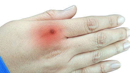 hand of a patient, Bruises caused by the action Until causing a scar on the left hand ridge, Bruise on young woman hand, isolate on white background and clipping path hand.
