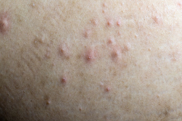 Acne on the human skin that is caused by the cover on the face.