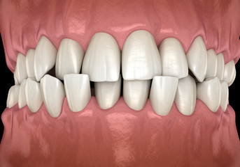 Anterior crossbite dental occlusion ( Malocclusion of teeth ). Medically accurate tooth 3D illustration