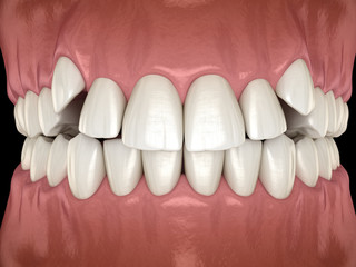 Fototapeta na wymiar Impacted incisors, overcrowded teeth. Medically accurate 3D illustration of abnormal dental occlusion