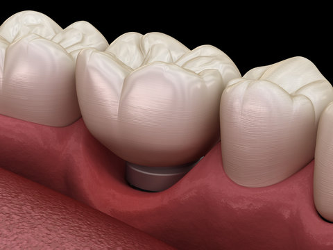 Peri-implantitis with visible gum recession. Medically accurate 3D illustration of dental implants concept