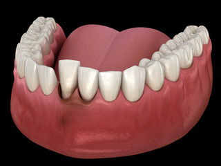 Tooth dislocation after trauma. Medically accurate 3D illustration
