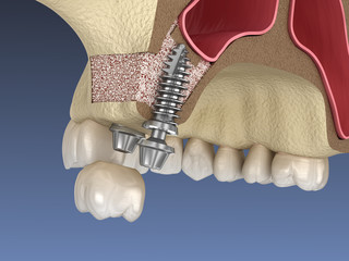 Sinus Lift Surgery - implant installation. 3D illustration © Alex Mit