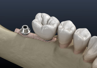 Cleavage of the alveolar ridge : implantation. Dental surgery, 3D illustration