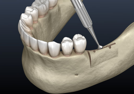Cleavage of the alveolar ridge, augmentation. Dental surgery, 3D illustration
