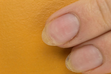 Onychomycosis of a nail disease in which the nails exfoliate