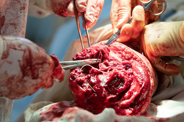 Surgeon sews muscles and tissues of amputated leg during the surgery close-up