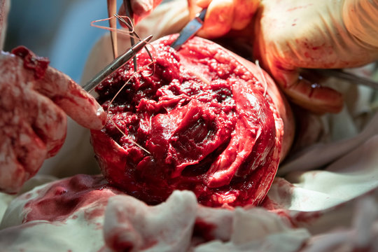 Sewing the wound after leg amputation with bended needle closeup