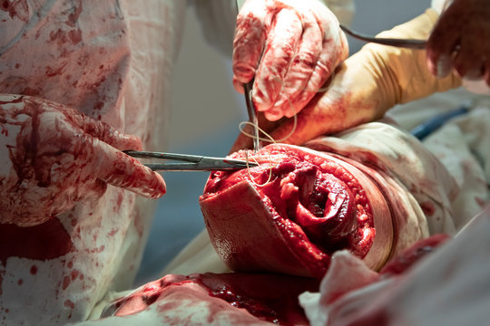 Surgeon sews the edge of skin making the stump after the leg amputation close-up