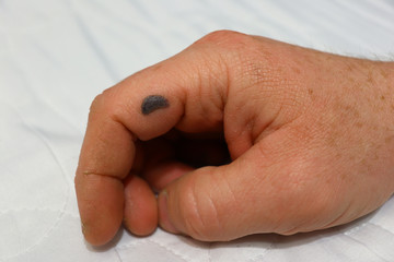 hematoma on the arm in the form of corns with blood on the man’s arm