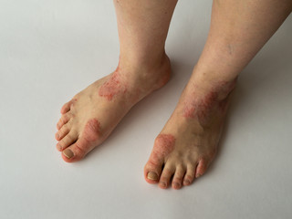 Closeup of the legs of a woman suffering from chronic psoriasis on a white background. Closeup of rash and scaling on the patient's skin. Dermatological problems. Dry skin. Isolated.