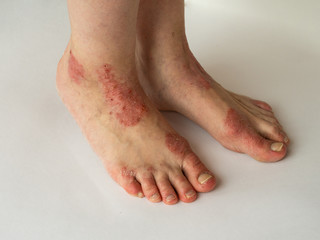 Closeup of the legs of a woman suffering from chronic psoriasis on a white background. Closeup of...