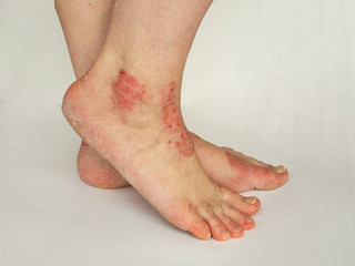 Closeup of the legs of a woman suffering from chronic psoriasis on a white background. Closeup of...