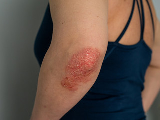 Fototapeta premium Psoriasis on elbow. Isolated. Closeup of rash and scaling on the patient's skin. The concept of chronic disease treatment. Dermatological problems. Hard, horny and cracked skin in woman's hands.