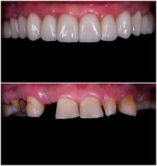 full mought recovery by press ceramic crowns and implants