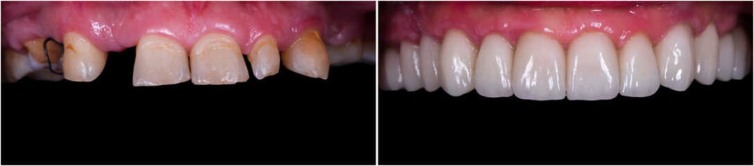 full mought recovery by press ceramic crowns and implants