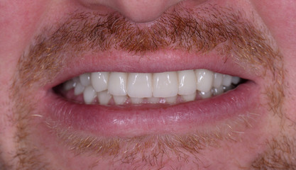 full mought recovery by press ceramic crowns and implants © Garo