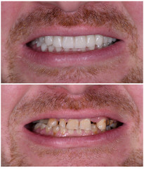 full mought recovery by press ceramic crowns and implants