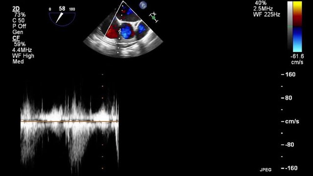 Transesophageal ultrasound video in Doppler mode.