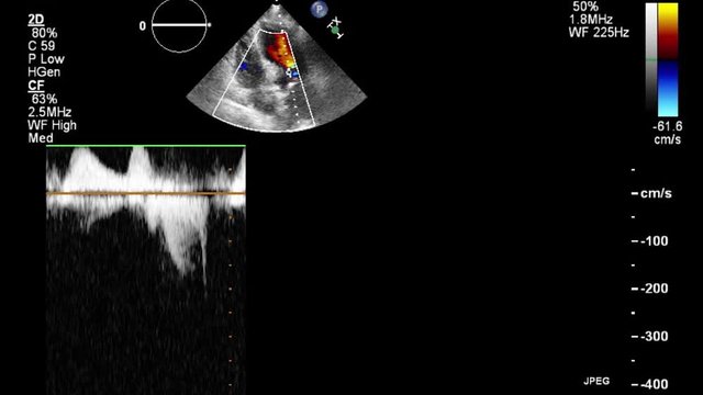 Transesophageal ultrasound video in Doppler mode.