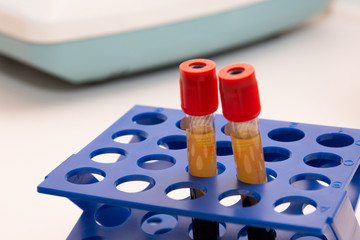 Two test-tubes with plazma in cells, prp laboratory