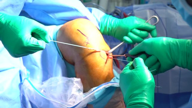 Doctor pulling out damaged ligament from patients knee for ACL reconstruction surgery