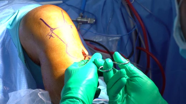 Doctor cutting knee for ACL reconstruction surgery
