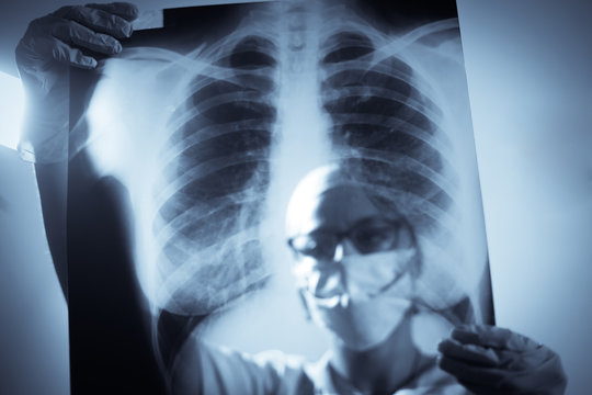 Doctor holding and analyzing an x-ray of some lungs