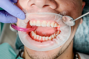Demonstration of teeth with a saliva pump at a dentist's appointment