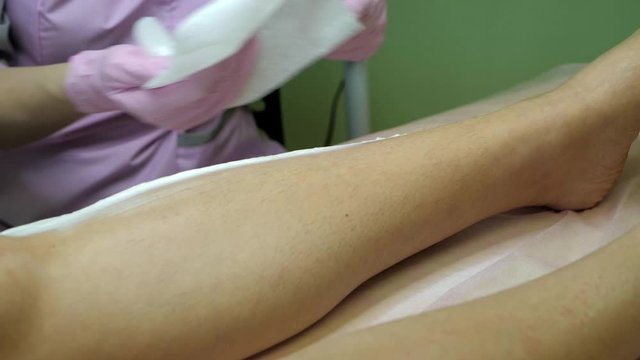 Doctor, beautician is cleaning patient's legs with help of foan and napkins. Cosmetologist, hair removal master is doing pain medication before the procedure. 