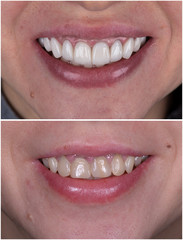full upper jaw reconstraction by press cermic crowns and veneers