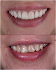 full upper jaw reconstraction by press cermic crowns and veneers © Garo