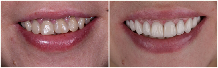 full upper jaw reconstraction by press cermic crowns and veneers