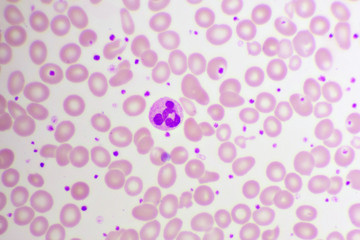 Essential thrombocytosis blood smear, present abnormal high platelet and white blood cell