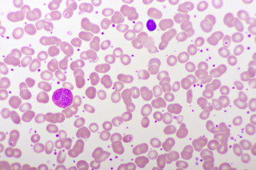 Essential thrombocytosis blood smear, present abnormal high platelet and white blood cell
