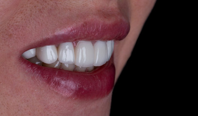 full upper jaw reconstraction by press cermic crowns and veneers