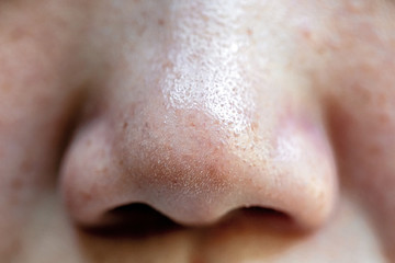 Pimples and pores in the nose of Asian people
