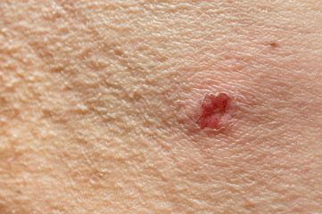 Itchy skin.Torn skin at the site of inflammation. Peeling and combing of the skin with various skin...