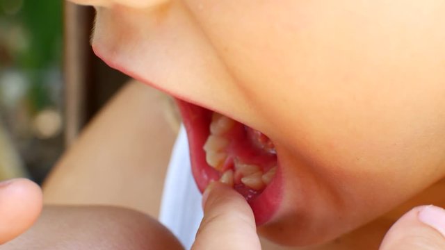 Child tries to pull out his second tooth with his fingers